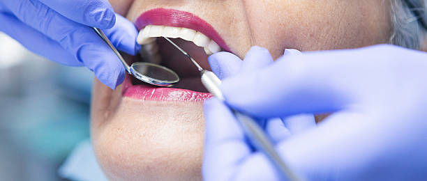 Best Knocked-Out Tooth (Avulsed Tooth) Treatment in Julesburg, CO